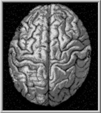Schizophrenia